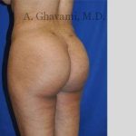 Buttock Augmentation Before & After Patient #7565