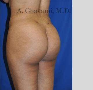 Buttock Augmentation Before & After Patient #7565