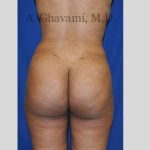 Buttock Augmentation Before & After Patient #7565