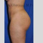 Buttock Augmentation Before & After Patient #7565