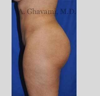 Buttock Augmentation Before & After Patient #7565