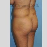 Buttock Augmentation Before & After Patient #7565