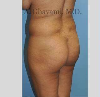 Buttock Augmentation Before & After Patient #7565