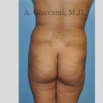 Buttock Augmentation Before & After Patient #7565