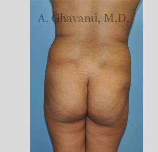 Buttock Augmentation Before & After Patient #7565