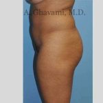 Buttock Augmentation Before & After Patient #7565