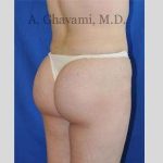 Buttock Augmentation Before & After Patient #7558