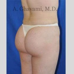 Buttock Augmentation Before & After Patient #7558