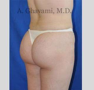 Buttock Augmentation Before & After Patient #7558