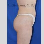 Buttock Augmentation Before & After Patient #7558