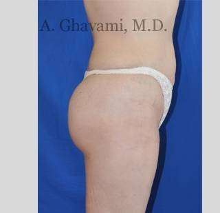 Buttock Augmentation Before & After Patient #7558