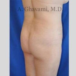 Buttock Augmentation Before & After Patient #7558