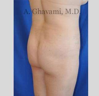 Buttock Augmentation Before & After Patient #7558