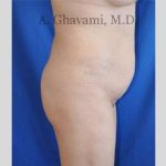 Buttock Augmentation Before & After Patient #7558