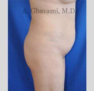 Buttock Augmentation Before & After Patient #7558