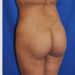 Buttock Augmentation Before & After Patient #7553