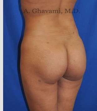 Buttock Augmentation Before & After Patient #7553