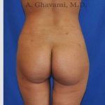 Buttock Augmentation Before & After Patient #7553