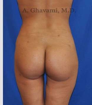 Buttock Augmentation Before & After Patient #7553