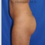 Buttock Augmentation Before & After Patient #7553