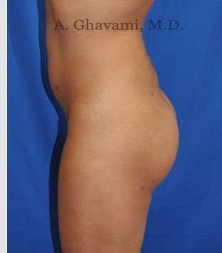 Buttock Augmentation Before & After Patient #7553