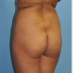 Buttock Augmentation Before & After Patient #7553