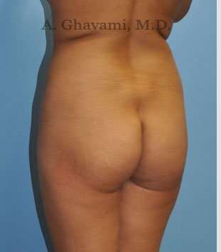 Buttock Augmentation Before & After Patient #7553