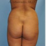 Buttock Augmentation Before & After Patient #7553