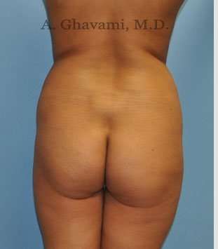 Buttock Augmentation Before & After Patient #7553