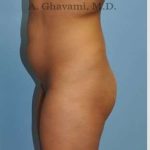 Buttock Augmentation Before & After Patient #7553