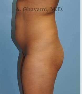 Buttock Augmentation Before & After Patient #7553
