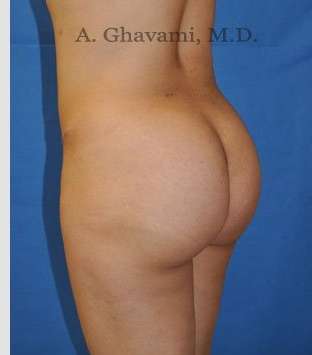 Buttock Augmentation Before & After Patient #7546