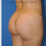 Buttock Augmentation Before & After Patient #7546
