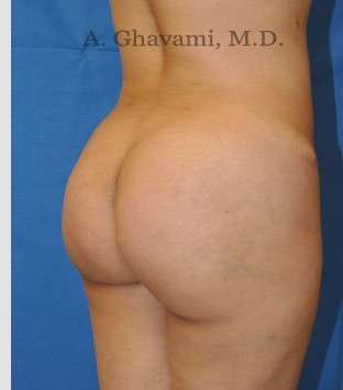 Buttock Augmentation Before & After Patient #7546