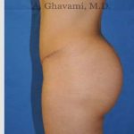 Buttock Augmentation Before & After Patient #7546