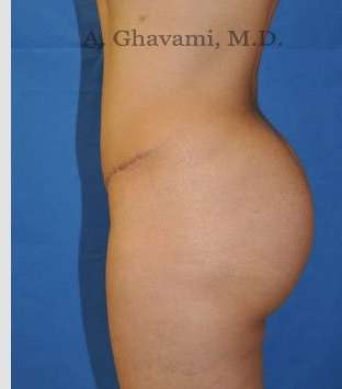 Buttock Augmentation Before & After Patient #7546
