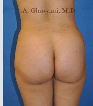 Buttock Augmentation Before & After Patient #7546