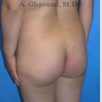 Buttock Augmentation Before & After Patient #7546