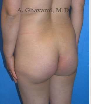 Buttock Augmentation Before & After Patient #7546