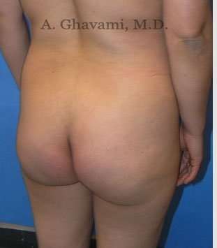 Buttock Augmentation Before & After Patient #7546