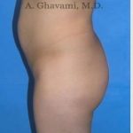 Buttock Augmentation Before & After Patient #7546