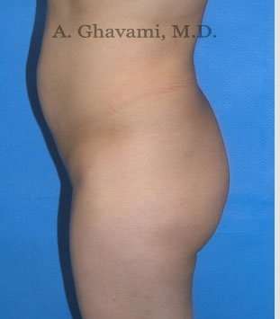 Buttock Augmentation Before & After Patient #7546