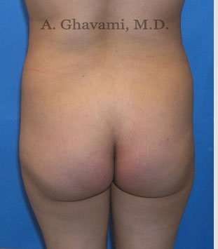 Buttock Augmentation Before & After Patient #7546