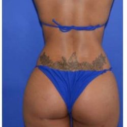 Buttock Augmentation Before & After Patient #7537
