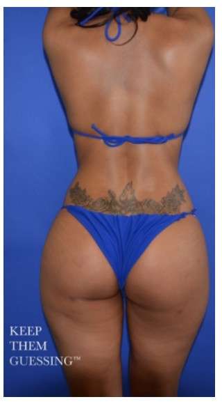 Buttock Augmentation Before & After Patient #7537
