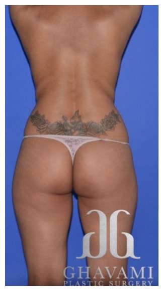 Buttock Augmentation Before & After Patient #7537