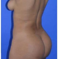 Buttock Augmentation Before & After Patient #7534