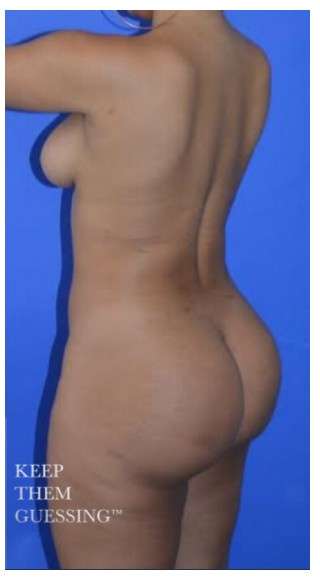 Buttock Augmentation Before & After Patient #7534