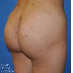 Buttock Augmentation Before & After Patient #7531
