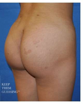Buttock Augmentation Before & After Patient #7531